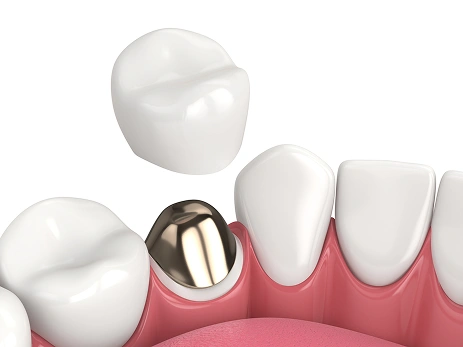 Endodontics dental implants