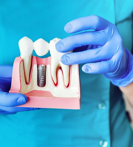 Arlington dental-imaplants