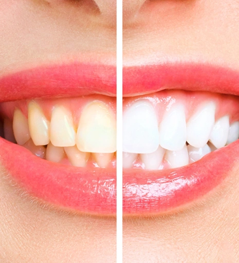 Teeth Whitening arlington
