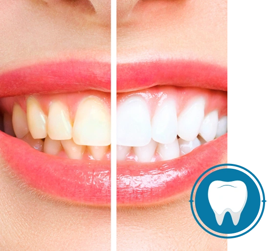 Teeth Whitening before and after