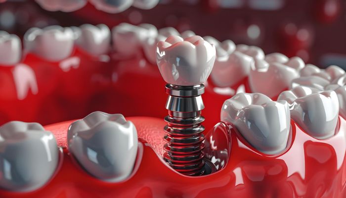 Right Dentist for Dental Implants in Arlington VA